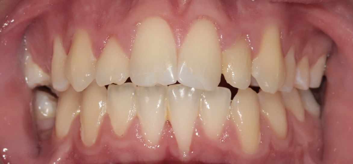 tipping molar illustration